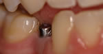 Dental Implants in Oxford OH Dentist