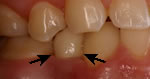 Dental Implant Restoration with Dr. Nathan Lloyd near Cincinnati OH