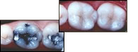 White Fillings in Ohio Oxford Dentist