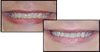 Immediate Teeth Whitening Results with Oxford OH Dentist Dr. Lloyd